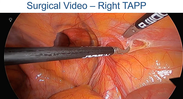 Overview of Laparoscopic Approach for Inguinal Hernia and Demonstration of TAPP 